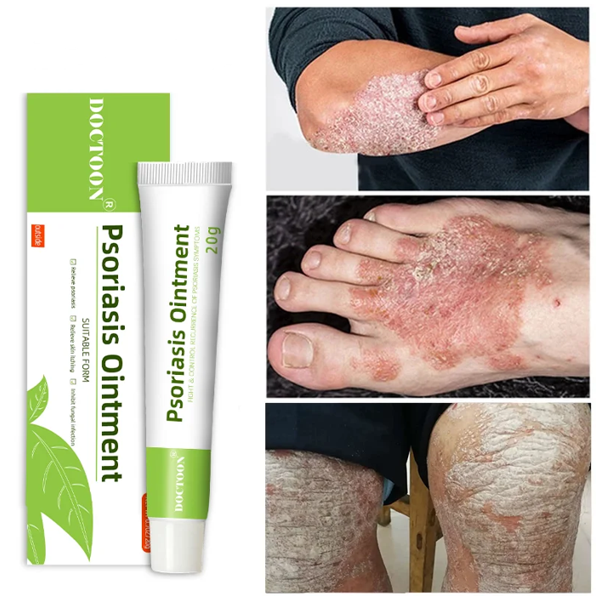 Psoriasis Cream Vitiligo Eczema Ointment In Pkaistan